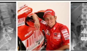 Casey Stoner Usai Operasi Otoplasa Casey Stoner Operasi Tulang Belakang