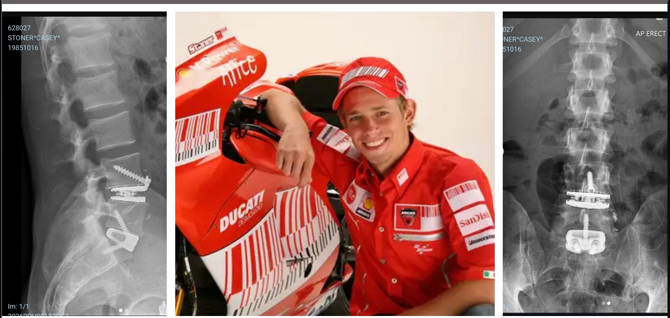 Casey Stoner Operasi Tulang Belakang