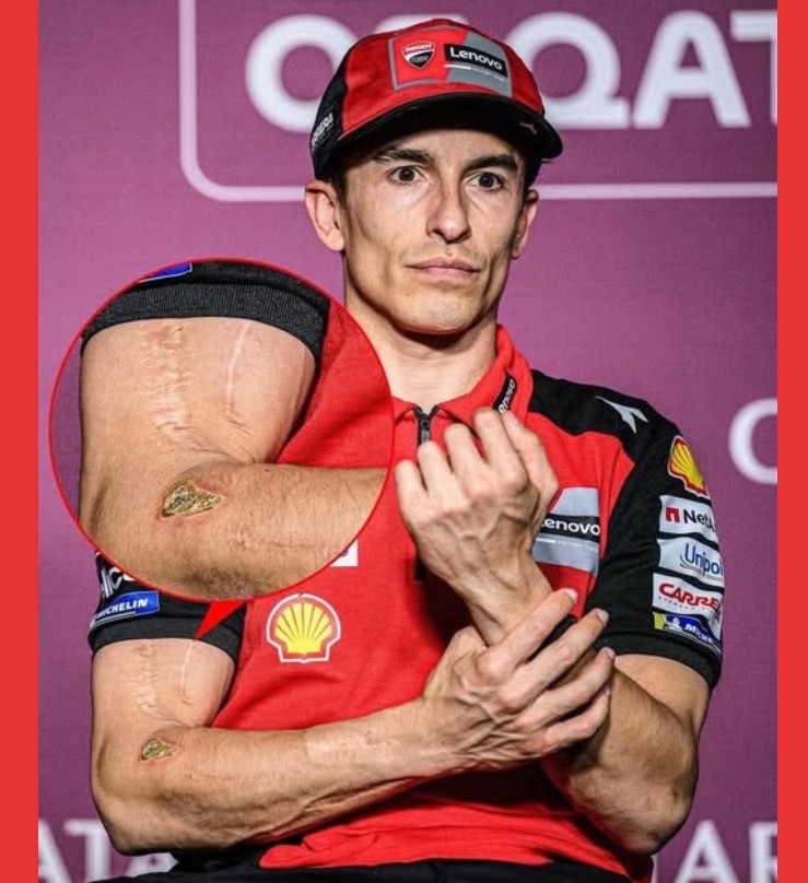 Marc Marquez Bekas Luka Otoplasa 10Agt2025 Marc Marquez Patah Tulang